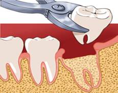 Dental extraction