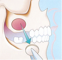 Bone grafts