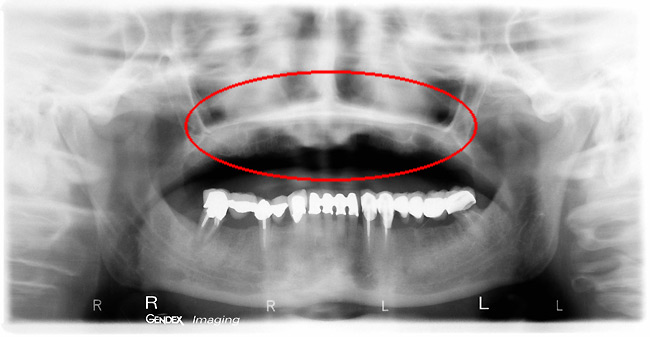 Bone grafts