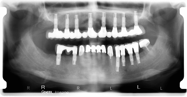 Dental bone grafts