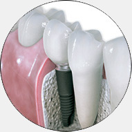 dental implants