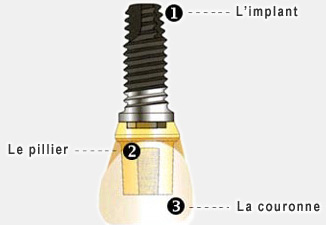 implants dentaires