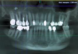 dental implants