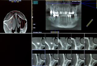 implants dentaires