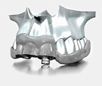 dental implants