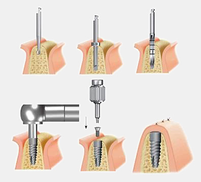 dental implants