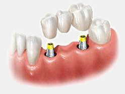 dental implants