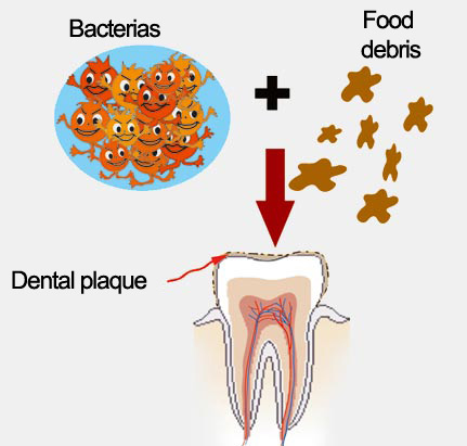 dantal plaque