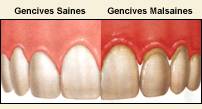 periodontal disease