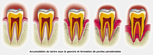 maladie parodontale