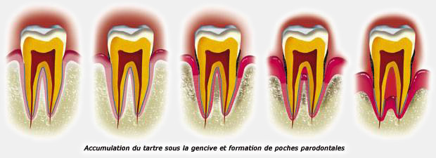 periodontal disease