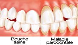 maladie parodontale