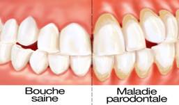 periodontal disease