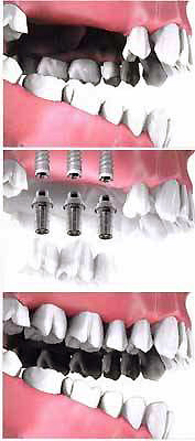 Temporary Prosthodontics