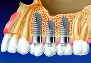 Temporary Prosthodontics