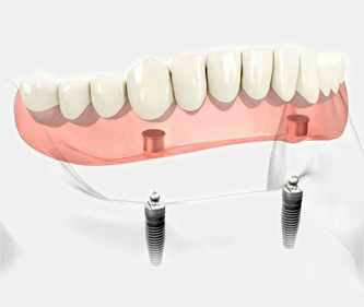 Dental prostheses