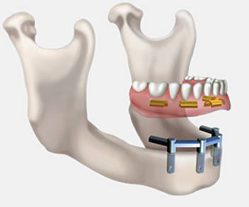 prothèse dentaires