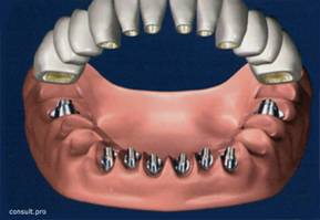 Dental prostheses