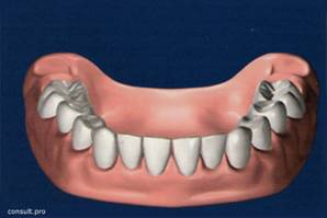 Dental prostheses