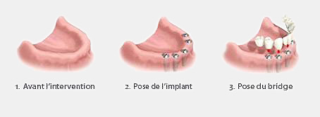 prothèse dentaires