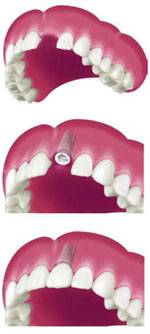 Dental prostheses