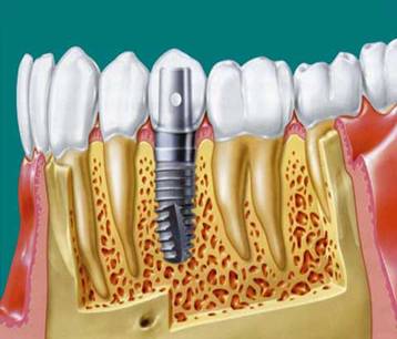 Dental prostheses