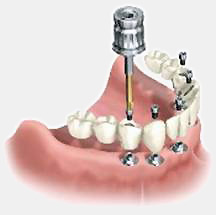 Dental prostheses