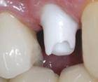 Dental prostheses